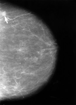 The arrow on this mammogram points to a small cancerous lesion. A lesion is an area of abnormal tissue change